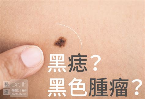 男生下面黑痣|不大驚小怪！如何辨別「黑痣」與「黑色腫瘤」？ 